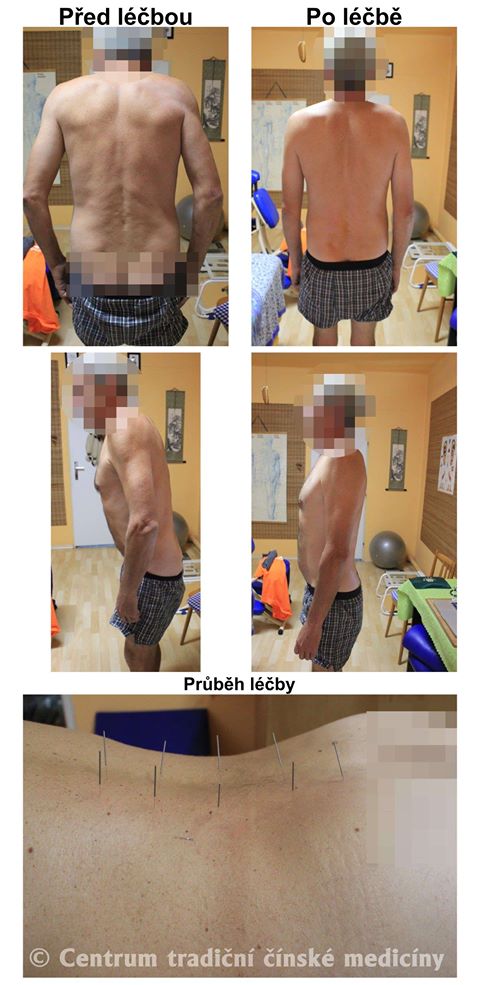 Právě si prohlížíte LÉČBA KOMPLETNÍ BLOKÁDY BEDERNÍ PÁTEŘE
