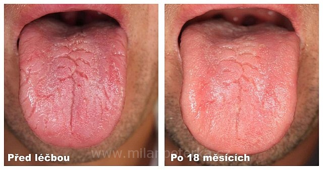 Právě si prohlížíte DIAGNOSTIKA Z JAZYKA