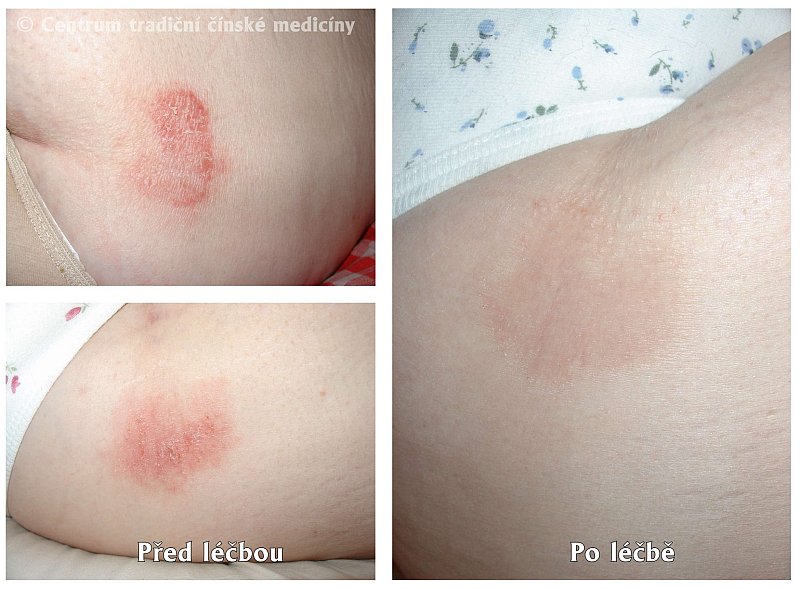 Právě si prohlížíte LÉČBA EKZÉMU