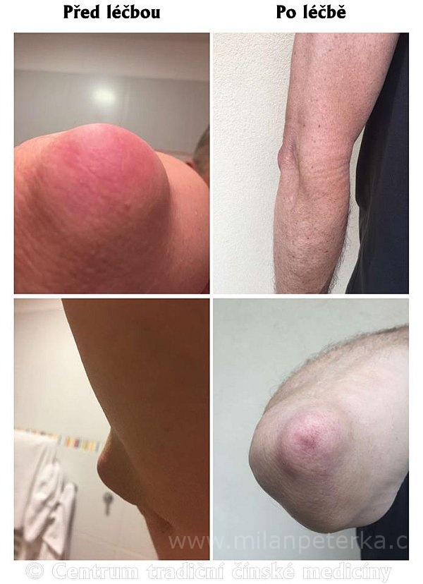 Právě si prohlížíte LÉČBA BURSITIS PRAVÉHO LOKETNÍM KLOUBU